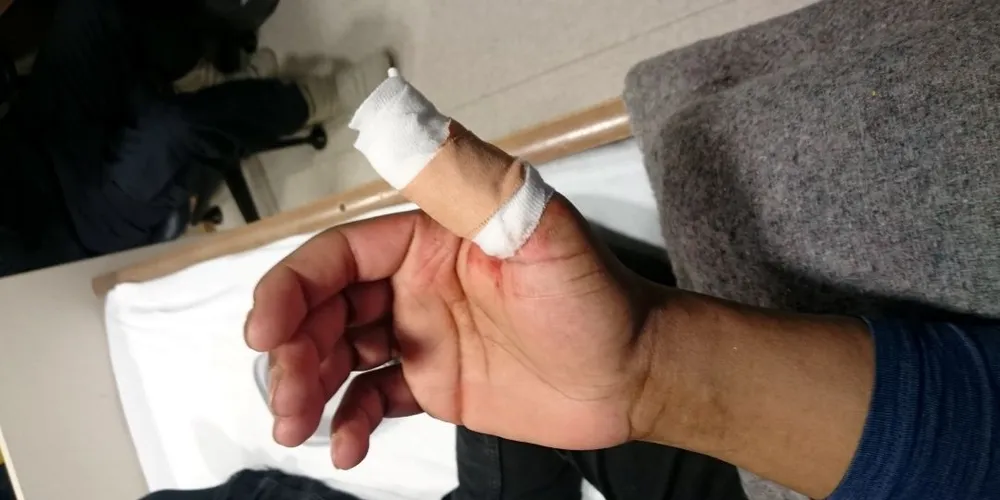En fisker om bord på «Grotle» var uheldig og fikk en krok i tommelen i forbindelse med klargjøring av lina. Det ser kanskje ikke så ille ut, men fiskeren kunne hatt en tommel mindre, hadde han ikke fått rask hjelp av mannskapet om bord på KV «Magnus Lagabøte». Foto: Kystvakten